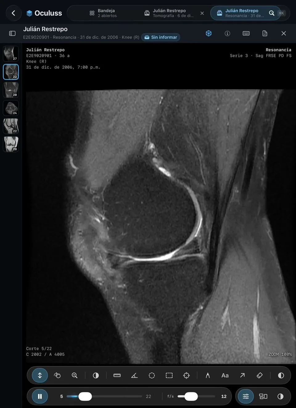 Una resonancia de rodilla abierta en el visor Oculuss, en el iPad